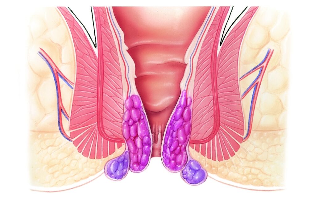 Hemoroid nedir